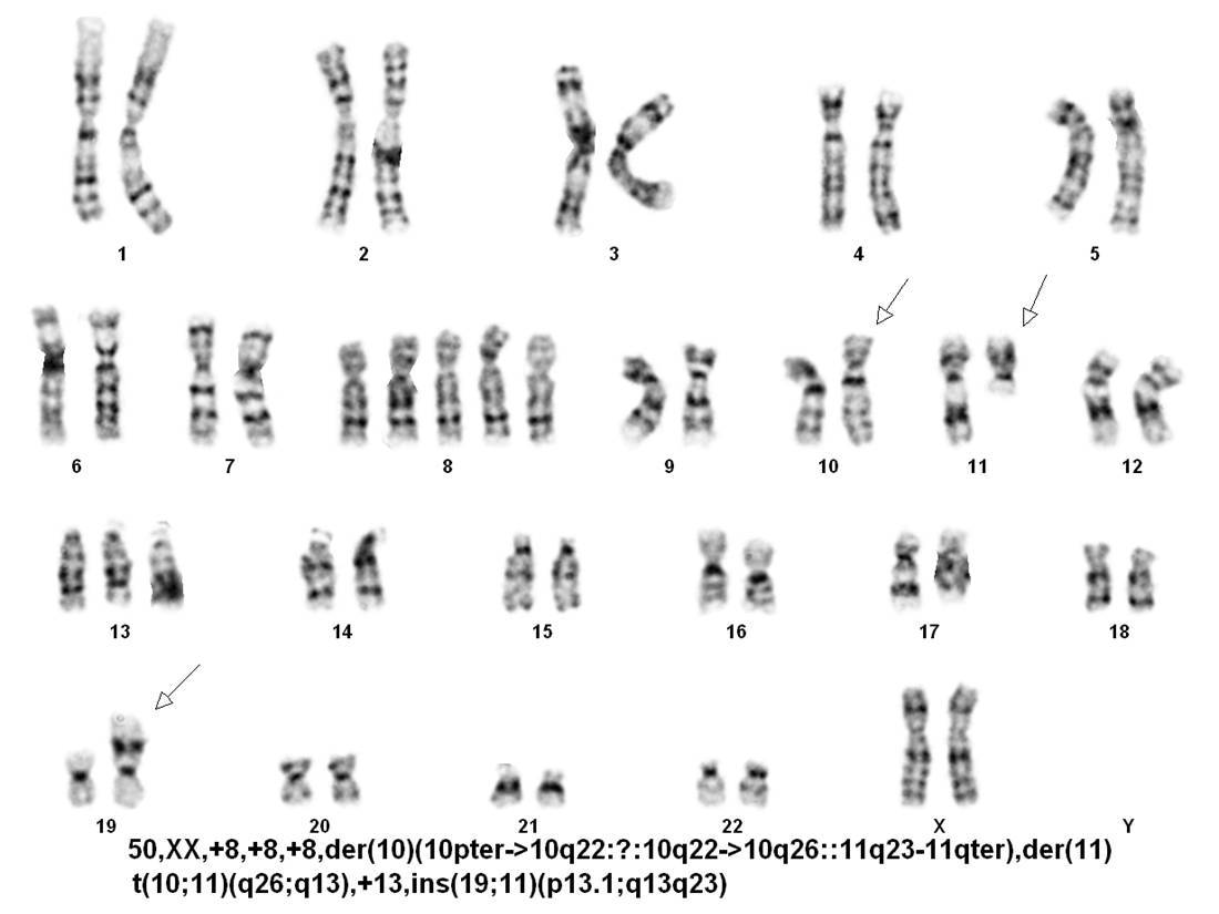 Figure 8. Karyotype of second bone marrow: involved side.